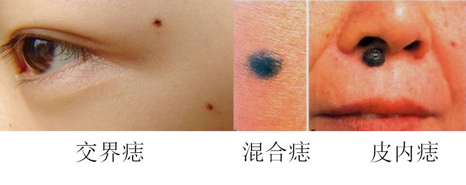 据 联合丽格第一医疗美容医院的医生介绍,皮内痣的痣细胞在皮肤中的