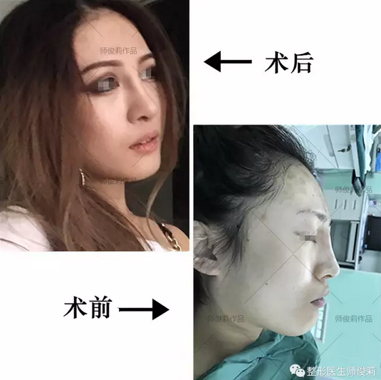 主页 项目中心 美容外科 鼻部整形 综合鼻整形  医生诊断:假体隆鼻术