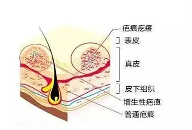 为疤痕疙瘩多因烧烫伤,创伤,痤疮,感染化脓或因采用手术,激光,冷冻